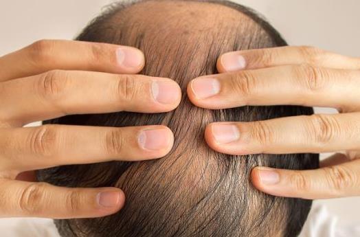 男性脫發的原因有哪些 職場壓力該怎么緩解