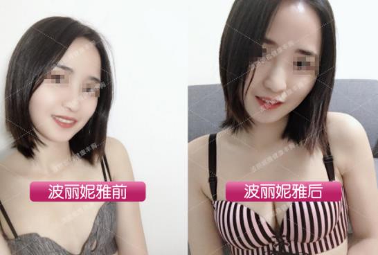 怎么豐胸效果比較好 先天胸小怎么變大?