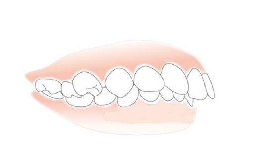 怎樣判斷是不是齙牙 齙牙會遺傳嗎