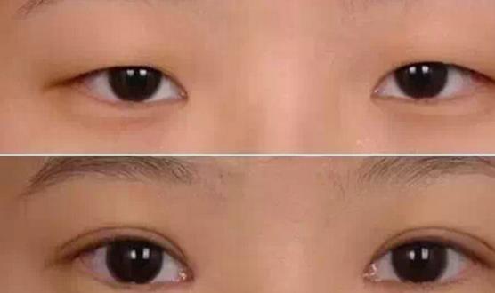 割雙眼皮哪個季節適合 什么時候割雙眼皮最好