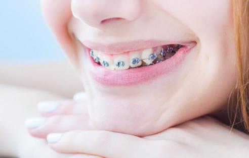 什么時(shí)候戴牙套好 戴牙套的最佳年齡是多少