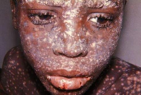 世界上最可怕的4種病毒排名,天花第一,西班牙流感病毒第二