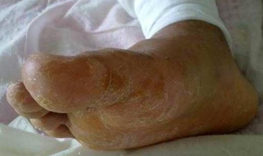 腳氣是身體在排毒嗎 腳氣會通過鞋子傳染嗎