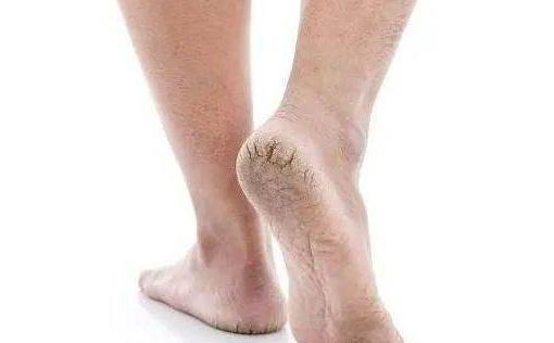 冬天腿上有大量的白色碎屑正常嗎 冬天腿上皮膚干燥起皮屑像下雪怎么辦