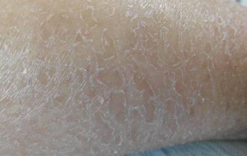 冬天腿上有大量的白色碎屑正常嗎 冬天腿上皮膚干燥起皮屑像下雪怎么辦