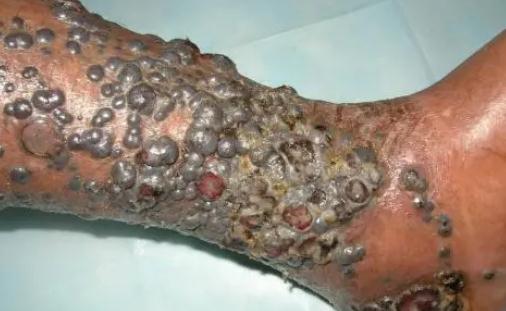 惡性黑色素瘤圖片 黑色素瘤最后有多痛苦