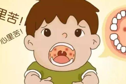 皰疹性咽峽炎是什么?皰疹性咽峽炎不能吃什么