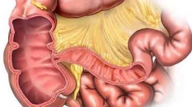 結腸癌不能吃哪些水果?結腸癌的危害是什么