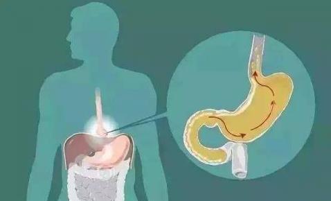 胃竇炎的癥狀是什么?胃竇炎不能吃什么