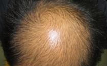 所謂“養腎補腎”防脫發，風牛馬不相及