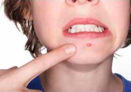 為什么下巴反復長痘痘？下巴反復長痘痘是什么原因