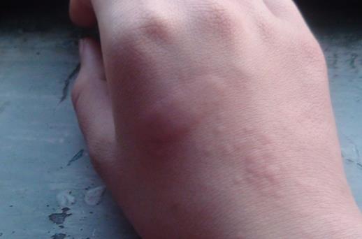 風疹的傳播途徑是什么? 如何更好的進行防治