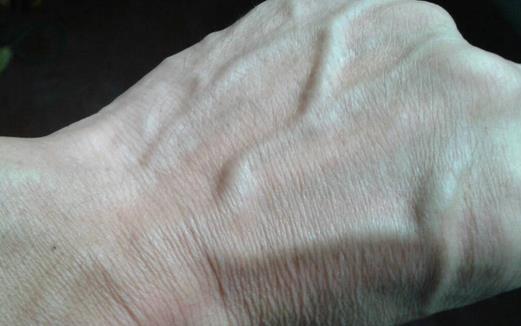 青筋凸出是病癥 正確調理保健康