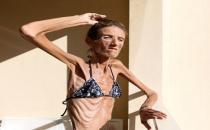 節食或導致精神障礙