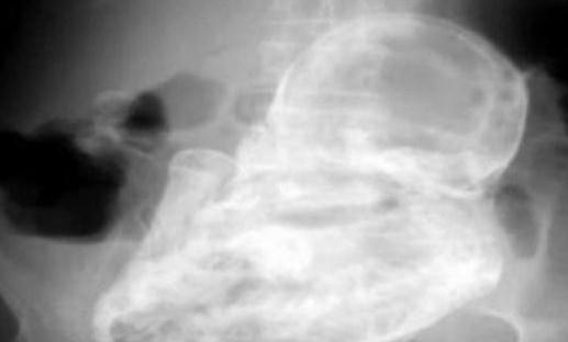 太嚇人，82歲老太太查出竟懷孕40年