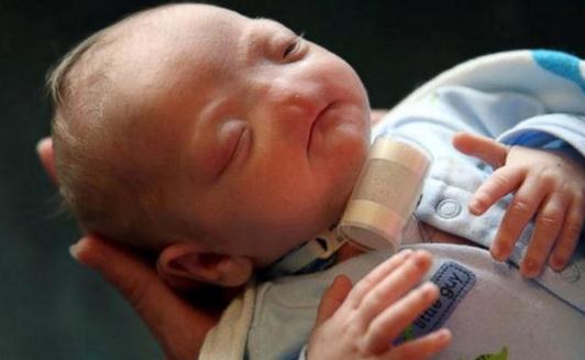 沒有鼻子的嬰兒，媽媽說他是完美的