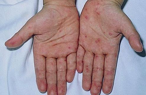 學生手掌出現紅點別大意