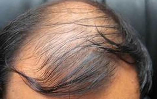 頭發一掉一大把 治療男性脫發的9個偏方