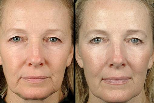 細(xì)數(shù)電波拉皮除皺的優(yōu)勢(shì)