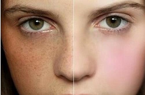 別讓曬斑爬上臉 5個祛斑技能