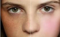 別讓曬斑爬上臉 5個祛斑技能