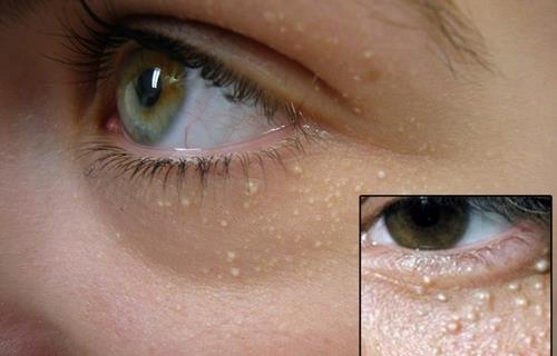 粒粒皆辛苦?找準原因輕松治脂肪粒!