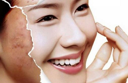 巧用妙招祛痘光滑肌膚常擁有