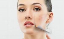 學會這七招解決痘痘問題