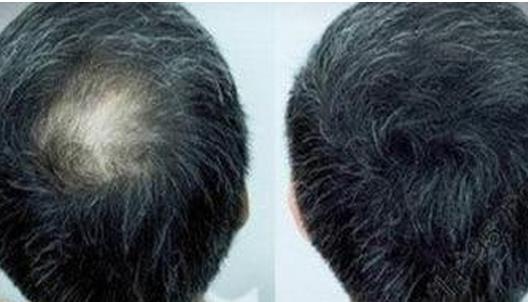 頭發種植的方式有哪些?