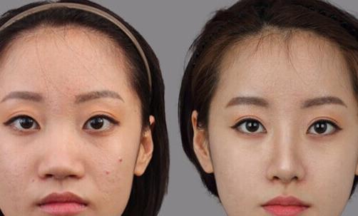 鼻翼整形術(shù)前6大禁忌 不可忽視