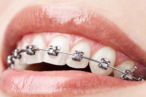 牙齒整形的幾個(gè)誤區(qū)要當(dāng)心