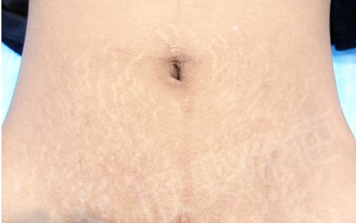 激光去妊娠紋的原理