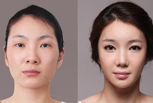 顴骨整形手術(shù)有什么優(yōu)勢(shì)呢