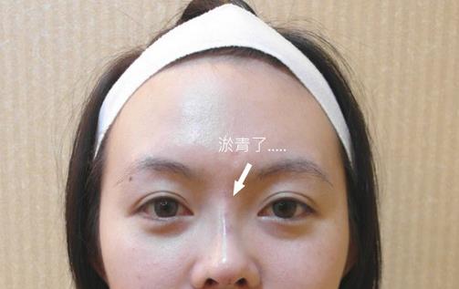 玻尿酸隆鼻維持時間