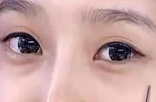 眼袋可不是臥蠶 它是怎么形成的