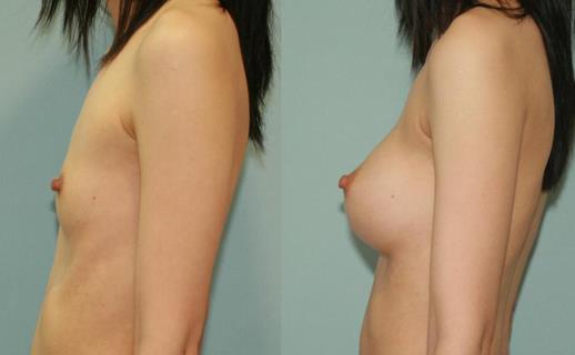 隆胸修復手術會不會疼痛