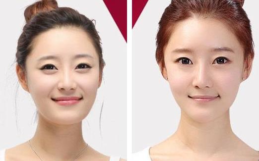 墊下巴有什么效果 會更美嗎