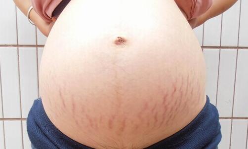 專家支招,如何預防和去除妊娠紋