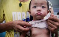 兒童性早熟發生率逐年增多