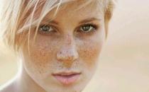 雀斑和吃鹽有關(guān)系？雀斑會(huì)遺傳嗎？