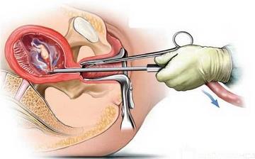 【引產】引產是什么癥狀_引產注意什么_引產吃什么補身體