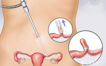 【女性結扎】女性結扎手術_結扎手術對女性的影響_女性結扎注意什么 【女性結扎】女性結扎手術_結扎手術對女性的影響_女性結扎注意什么