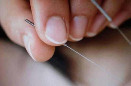 針灸美容幫你內外調節肌膚