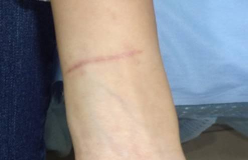 疤痕增生怎么辦