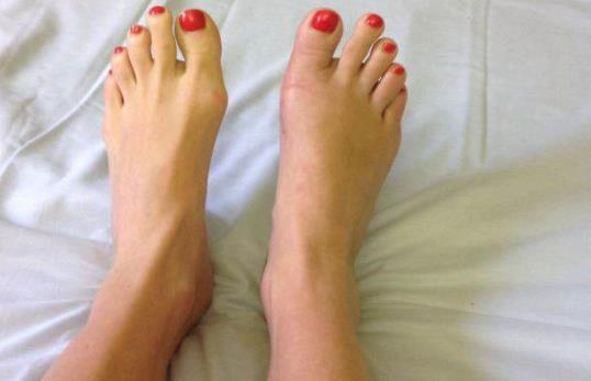 早上起來腳心疼怎么辦?