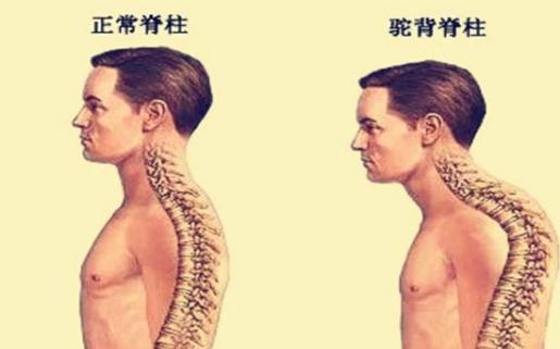 青少年如何預防駝背 做好以下的細節