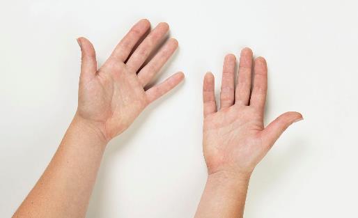 手心長(zhǎng)斑小心胃部健康