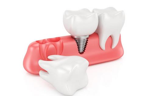 牙齒過早脫落當心是牙周炎！