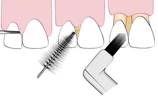 牙齦出血怎么回事?該如何預防牙齦出血
