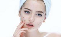 怎么擠痘痘才不會留下疤痕